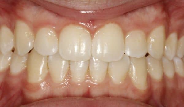 Invisalign: Teeth Crowding After