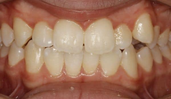 Invisalign: Teeth Crowding Before