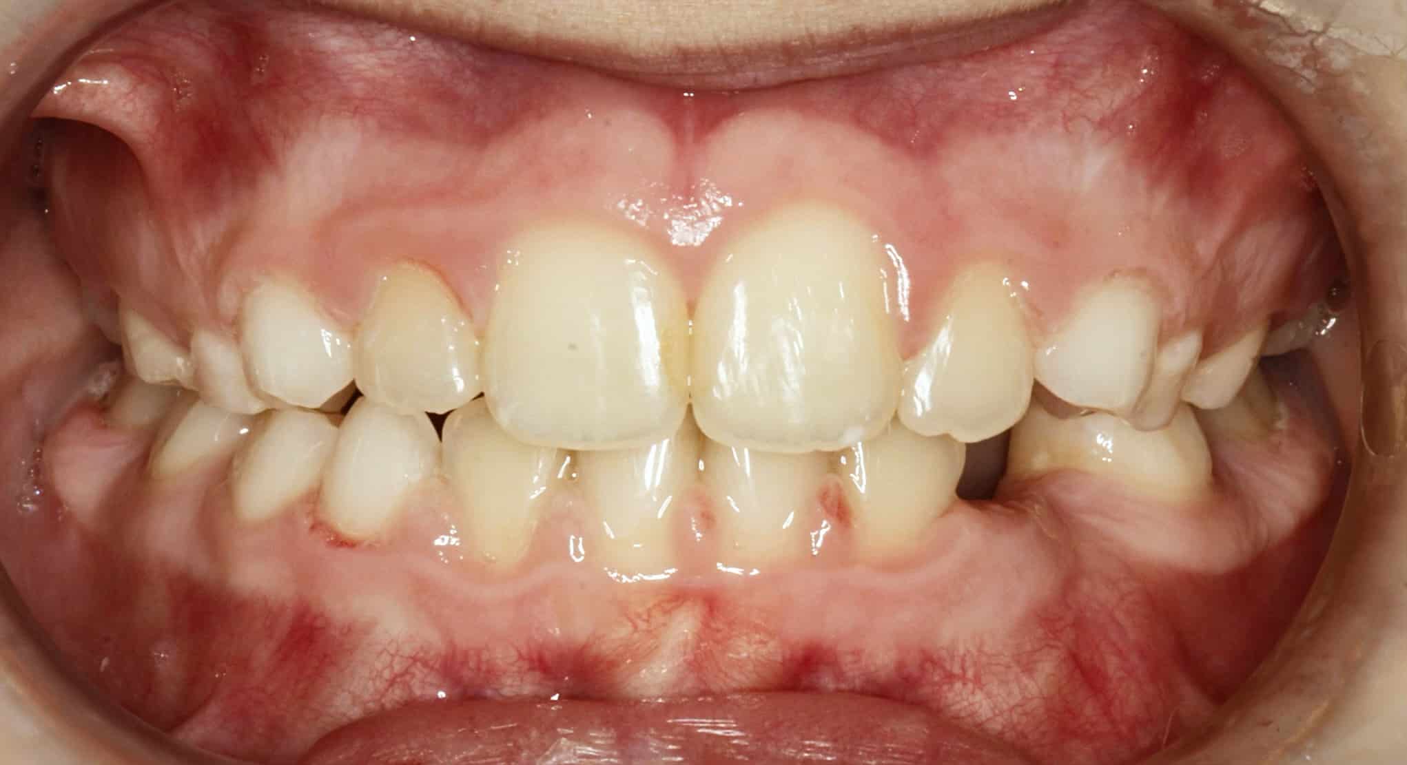 Youth Braces: Crowding & Open Bite After