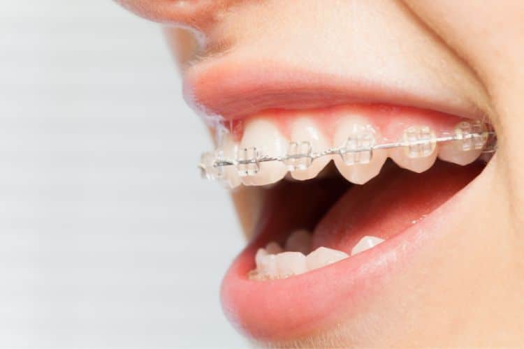 What Can I Eat With Braces?