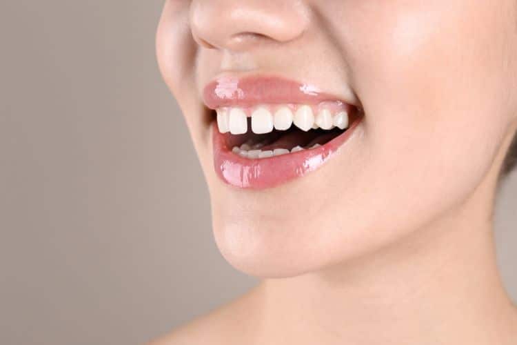 Orthodontic Solutions To Fix Gaps In Teeth