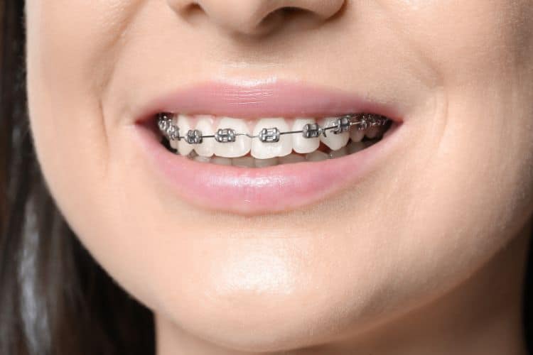 Braces Phases For Kids