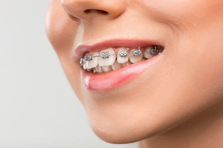 The Importance of Regular Dental Checkups During Orthodontic Treatment