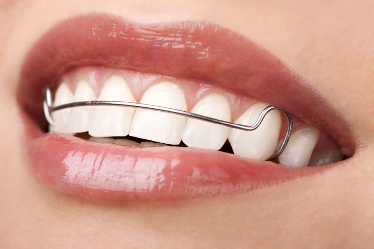 The Importance of Retainers After Braces