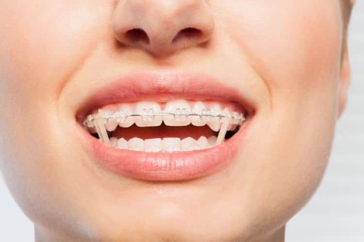 The Role of Elastics in Orthodontic Treatment